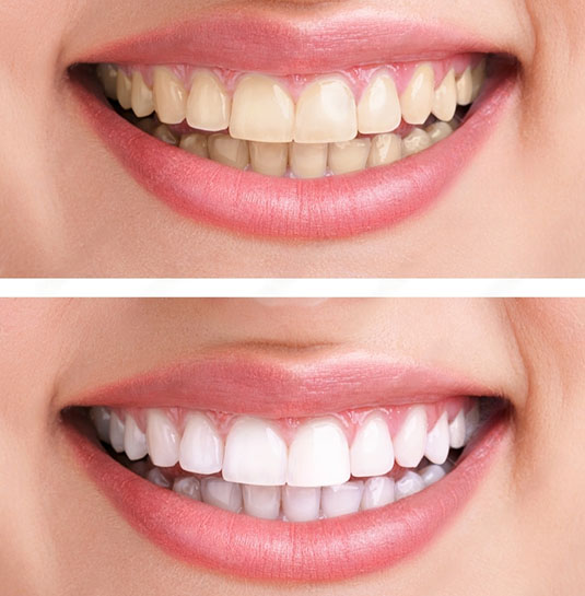 Teeth whitening