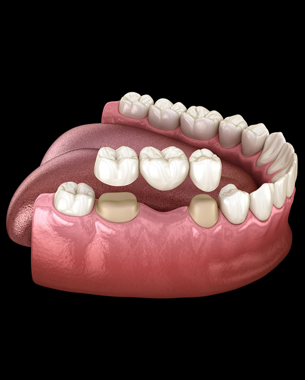 Dental Bridges