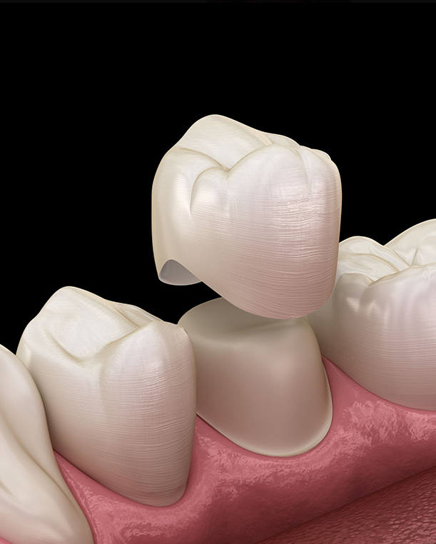 Dental Crowns