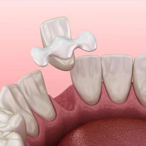 Dental Bridges