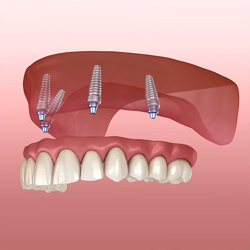 Dental Implants