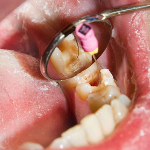 Root Canal Treatment