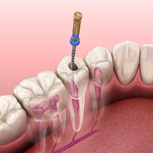 Root Canal Treatment