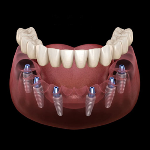 Dental Implants