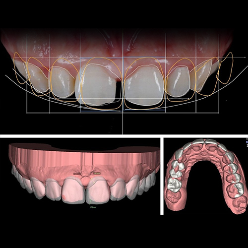 Smile Makeover