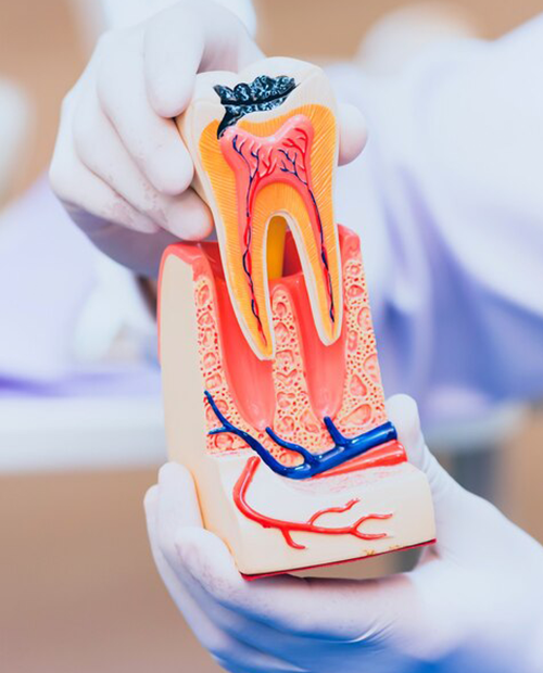 Root Canal Treatment