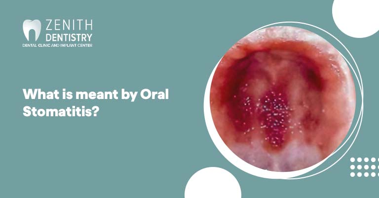 What is meant by Oral Stomatitis?