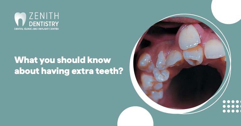 What you should know about having extra teeth?