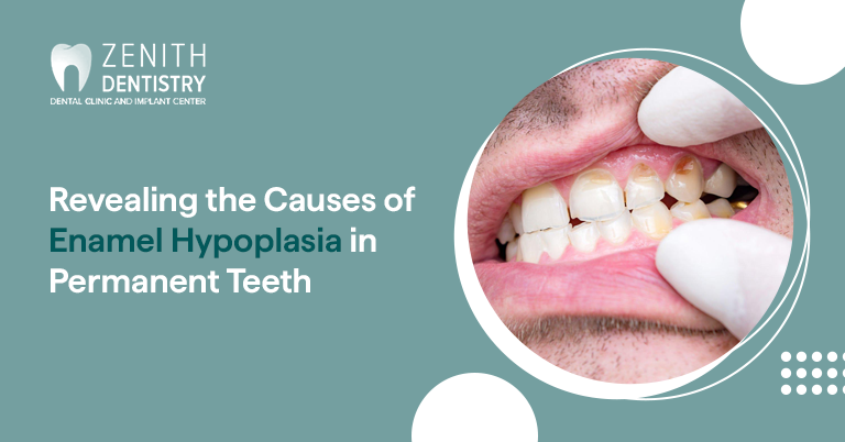 Revealing the Causes of Enamel Hypoplasia in Permanent Teeth