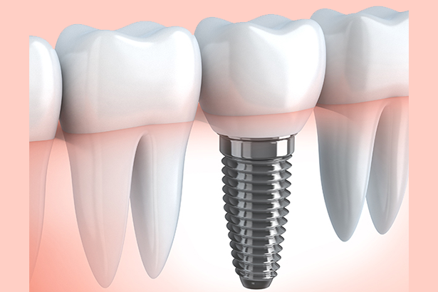 Dental Implants