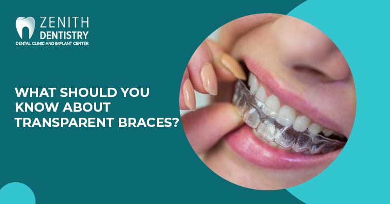 What should you know about transparent braces?