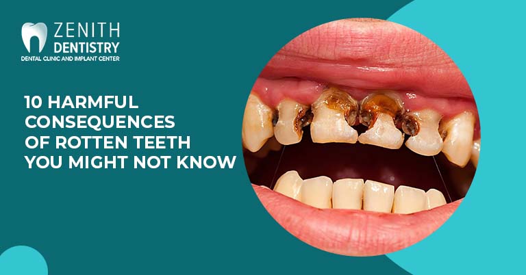 10 harmful consequences of Rotten Teeth you might not know