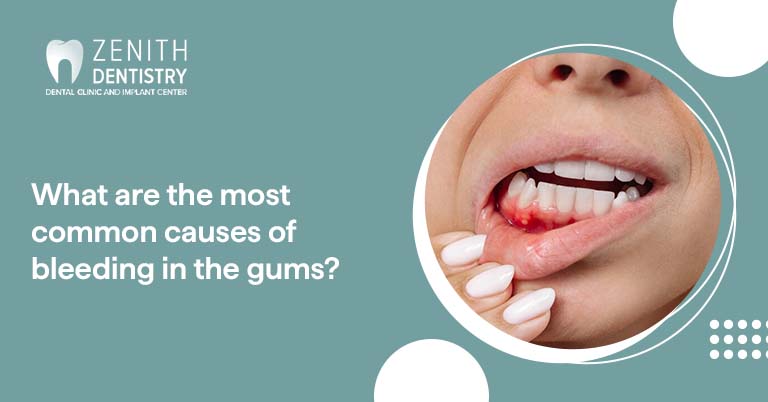 What are the most common causes of bleeding in the gums?