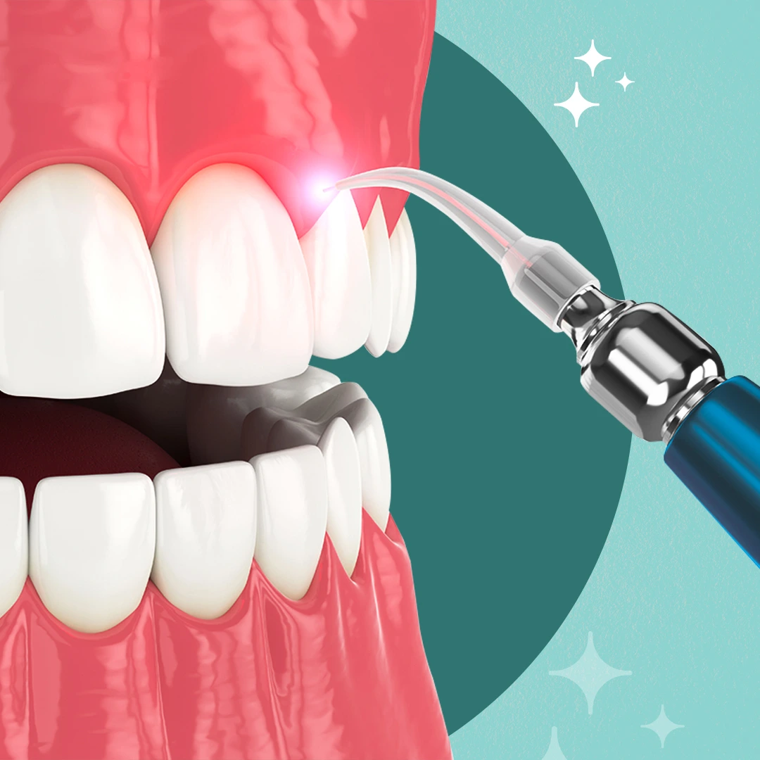 Laser Dentistry