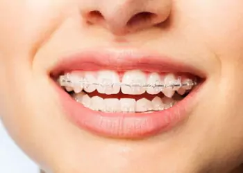 Ceramic braces