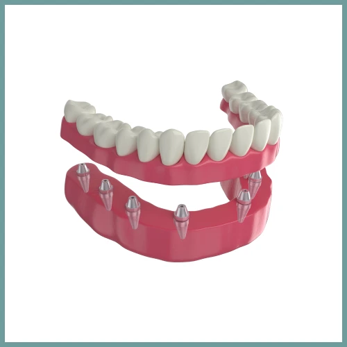 Dental Implants