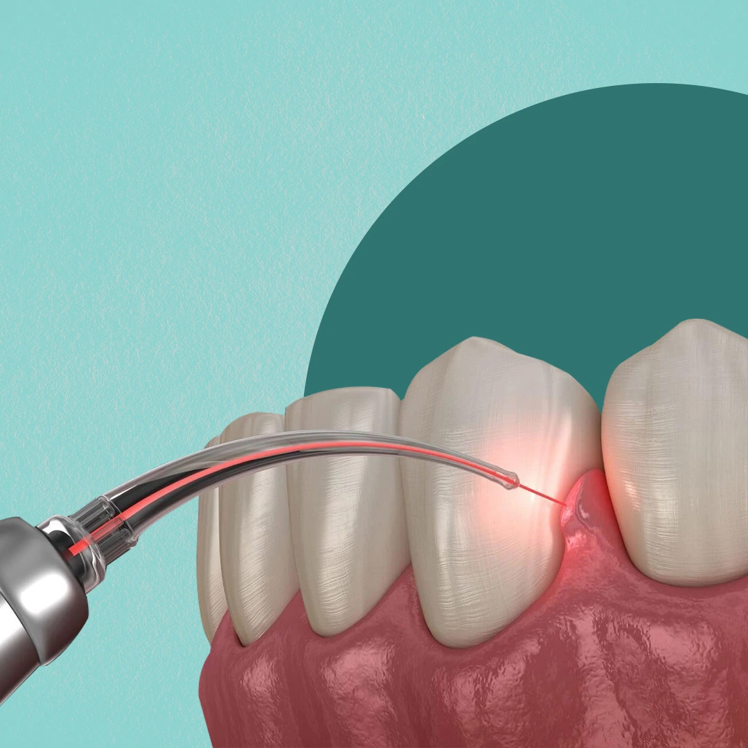 Laser Dentistry