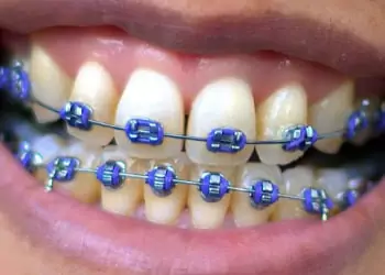 Metal braces