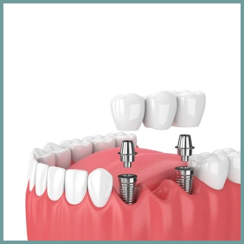 Dental Implants