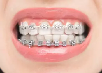 Self-ligating Braces