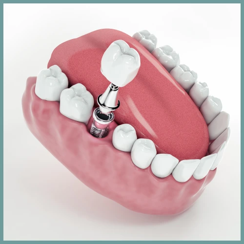 Dental Implants